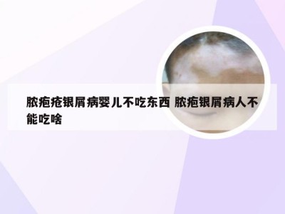 脓疱疮银屑病婴儿不吃东西 脓疱银屑病人不能吃啥