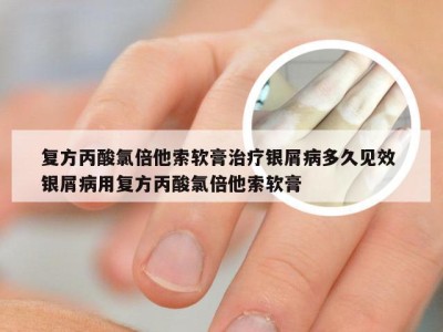 复方丙酸氯倍他索软膏治疗银屑病多久见效 银屑病用复方丙酸氯倍他索软膏