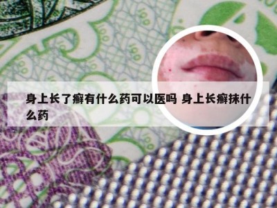 身上长了癣有什么药可以医吗 身上长癣抹什么药