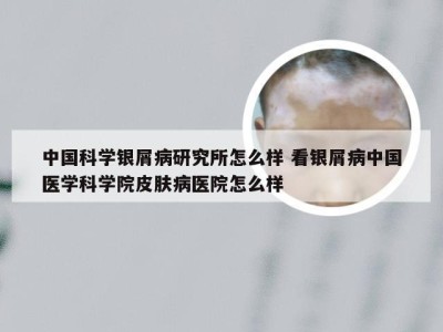 中国科学银屑病研究所怎么样 看银屑病中国医学科学院皮肤病医院怎么样