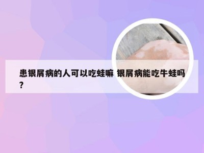 患银屑病的人可以吃蛙嘛 银屑病能吃牛蛙吗?