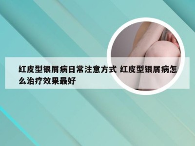 红皮型银屑病日常注意方式 红皮型银屑病怎么治疗效果最好