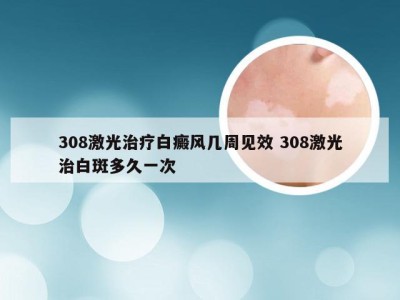 308激光治疗白癜风几周见效 308激光治白斑多久一次