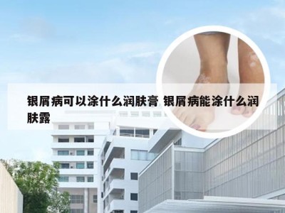 银屑病可以涂什么润肤膏 银屑病能涂什么润肤露