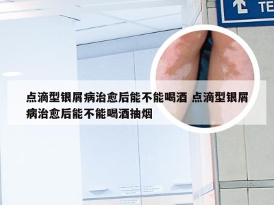 点滴型银屑病治愈后能不能喝酒 点滴型银屑病治愈后能不能喝酒抽烟