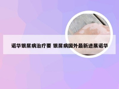 诺华银屑病治疗要 银屑病国外最新进展诺华