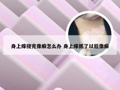 身上痒挠完像癣怎么办 身上痒抓了以后像癣