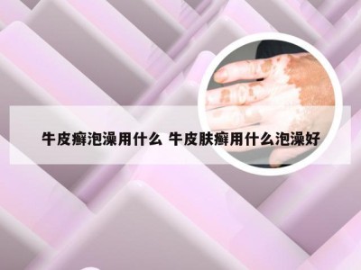 牛皮癣泡澡用什么 牛皮肤癣用什么泡澡好