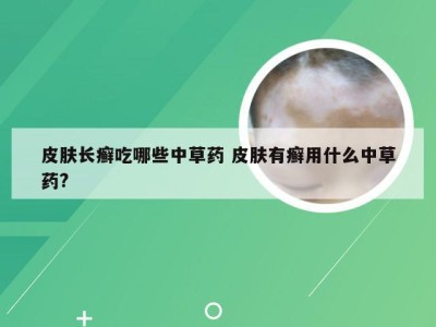 皮肤长癣吃哪些中草药 皮肤有癣用什么中草药?