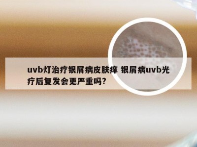 uvb灯治疗银屑病皮肤痒 银屑病uvb光疗后复发会更严重吗?