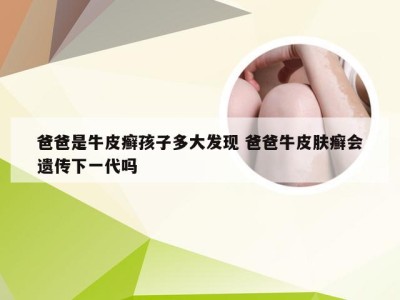 爸爸是牛皮癣孩子多大发现 爸爸牛皮肤癣会遗传下一代吗