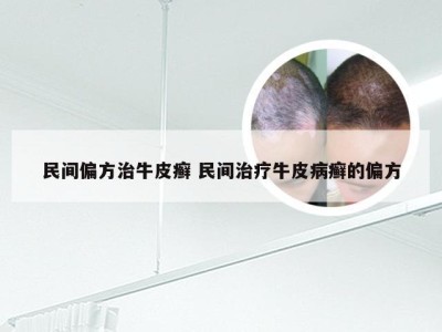 民间偏方治牛皮癣 民间治疗牛皮病癣的偏方