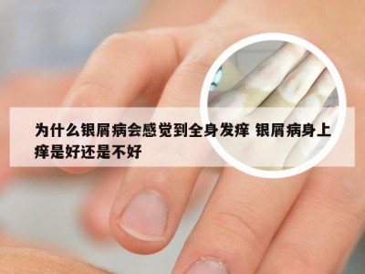 为什么银屑病会感觉到全身发痒 银屑病身上痒是好还是不好