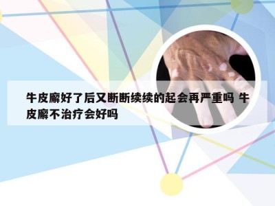 牛皮廨好了后又断断续续的起会再严重吗 牛皮廨不治疗会好吗