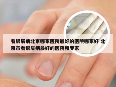 看银屑病北京哪家医院最好的医院哪家好 北京市看银屑病最好的医院和专家