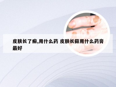 皮肤长了癣,用什么药 皮肤长藓用什么药膏最好