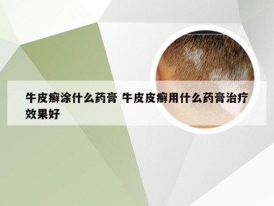 牛皮癣涂什么药膏 牛皮皮癣用什么药膏治疗效果好