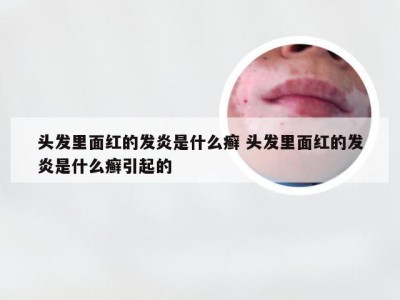 头发里面红的发炎是什么癣 头发里面红的发炎是什么癣引起的