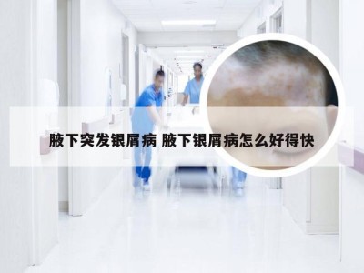 腋下突发银屑病 腋下银屑病怎么好得快