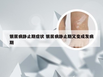 银屑病静止期症状 银屑病静止期又变成发病期