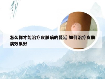 怎么样才能治疗皮肤病的蔓延 如何治疗皮肤病效果好