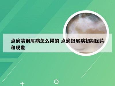 点滴装银屑病怎么得的 点滴银屑病初期图片和现象