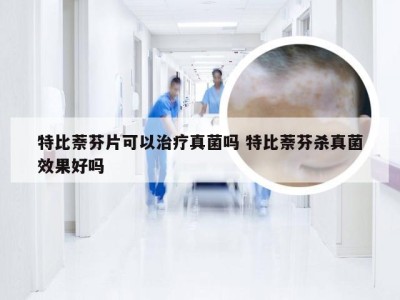 特比萘芬片可以治疗真菌吗 特比萘芬杀真菌效果好吗