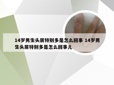 14岁男生头屑特别多是怎么回事 14岁男生头屑特别多是怎么回事儿