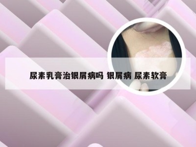 尿素乳膏治银屑病吗 银屑病 尿素软膏