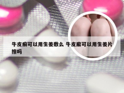 牛皮癣可以用生姜敷么 牛皮廨可以用生姜片擦吗