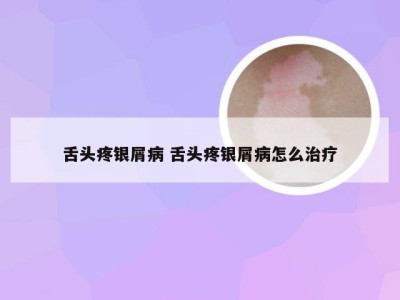 舌头疼银屑病 舌头疼银屑病怎么治疗