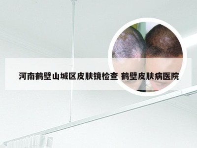 河南鹤壁山城区皮肤镜检查 鹤壁皮肤病医院