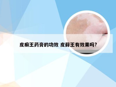 皮癣王药膏的功效 皮藓王有效果吗?