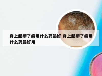 身上起癣了癣用什么药最好 身上起癣了癣用什么药最好用