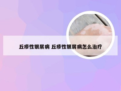 丘疹性银屑病 丘疹性银屑病怎么治疗