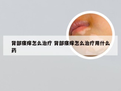 背部瘙痒怎么治疗 背部瘙痒怎么治疗用什么药