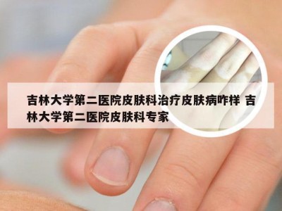 吉林大学第二医院皮肤科治疗皮肤病咋样 吉林大学第二医院皮肤科专家