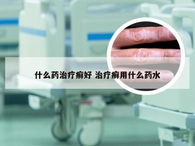 什么药治疗癣好 治疗癣用什么药水