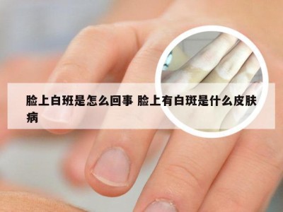 脸上白班是怎么回事 脸上有白斑是什么皮肤病