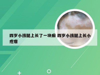 四岁小孩腿上长了一块癣 四岁小孩腿上长小疙瘩