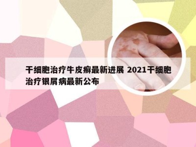 干细胞治疗牛皮癣最新进展 2021干细胞治疗银屑病最新公布