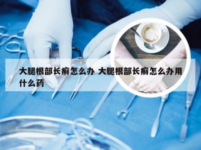 大腿根部长癣怎么办 大腿根部长癣怎么办用什么药