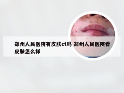 郑州人民医院有皮肤ct吗 郑州人民医院看皮肤怎么样