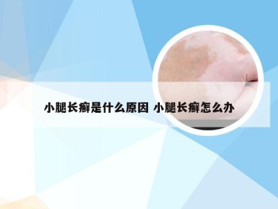 小腿长癣是什么原因 小腿长癣怎么办