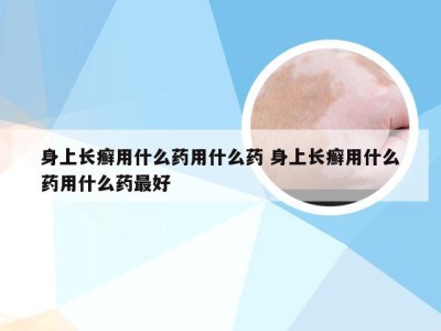 身上长癣用什么药用什么药 身上长癣用什么药用什么药最好