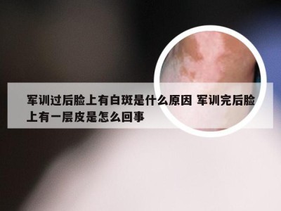 军训过后脸上有白斑是什么原因 军训完后脸上有一层皮是怎么回事