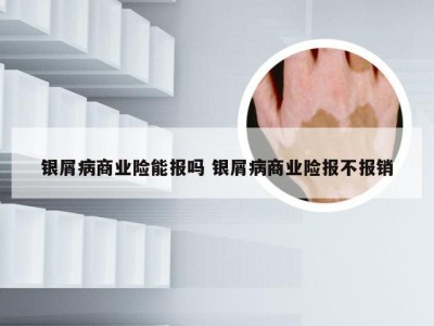 银屑病商业险能报吗 银屑病商业险报不报销