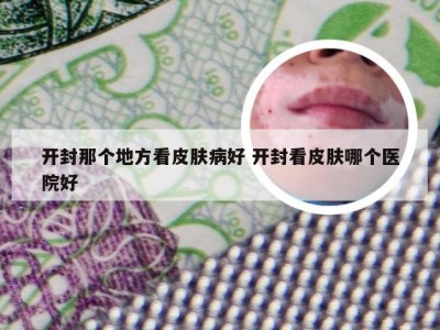 开封那个地方看皮肤病好 开封看皮肤哪个医院好