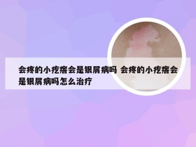 会疼的小疙瘩会是银屑病吗 会疼的小疙瘩会是银屑病吗怎么治疗