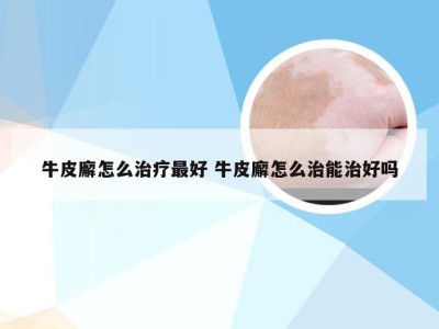 牛皮廨怎么治疗最好 牛皮廨怎么治能治好吗